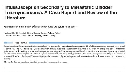 Intussusception secondary to metastatic bladder leiomyosarcoma